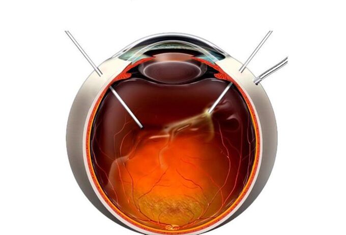 Vitrectomy An operation to restore vision
